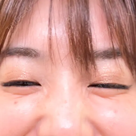 その他（目元） ももスキンケアクリニック BEFORE メイン用
