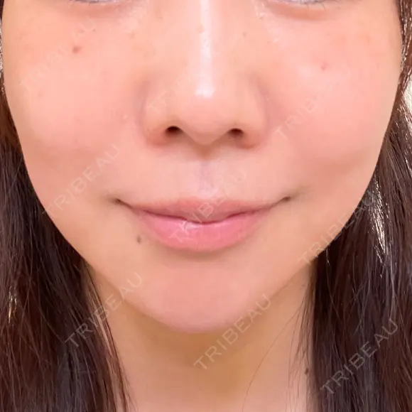 シミ取りレーザー ももスキンケアクリニック BEFORE メイン用