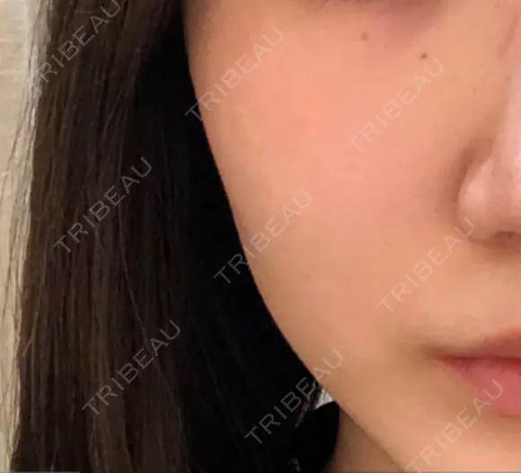 光治療（フォトフェイシャルなど） 代官山ウィメンズクリニック BEFORE メイン用