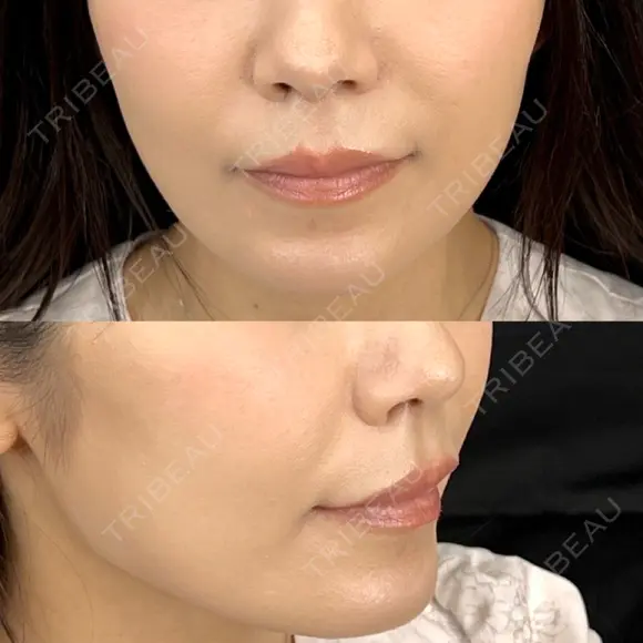 ヒアルロン酸注入（鼻翼基部） 藤・ナチュレ美容クリニック 恵比寿院 BEFORE メイン用