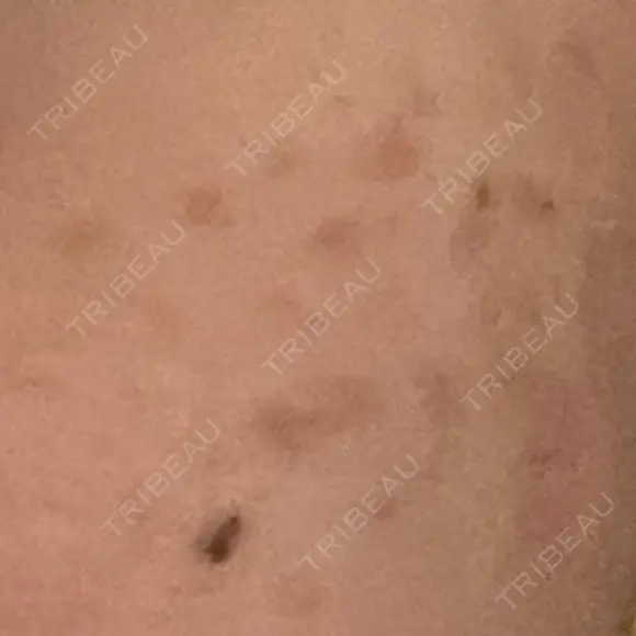 ピコスポット LOUIS CLINIC 二子玉川院【ルイクリニック】 BEFORE メイン用