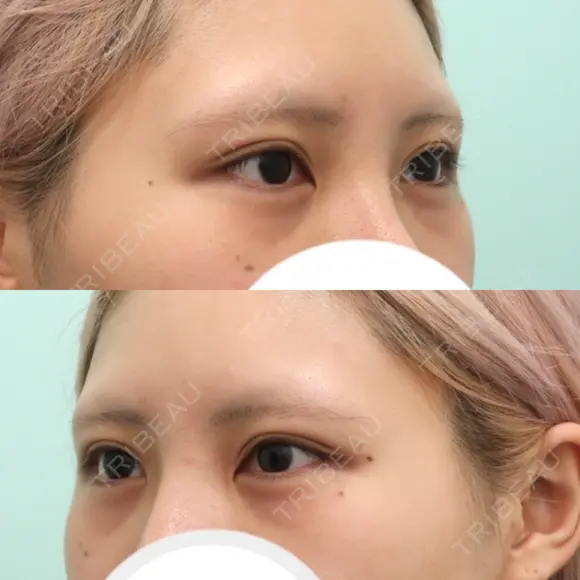 目頭切開 / 脂肪注入（目の下） WOM CLINIC GINZA （ワム クリニック ギンザ） BEFORE メイン用