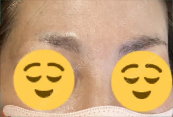 アートメイク（眉） メディカルアートメイク大阪 BEFORE メイン用