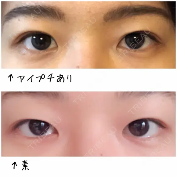 二重埋没 / その他（目元） / 上まぶたの脂肪取り 東京形成美容外科 船橋院 BEFORE メイン用