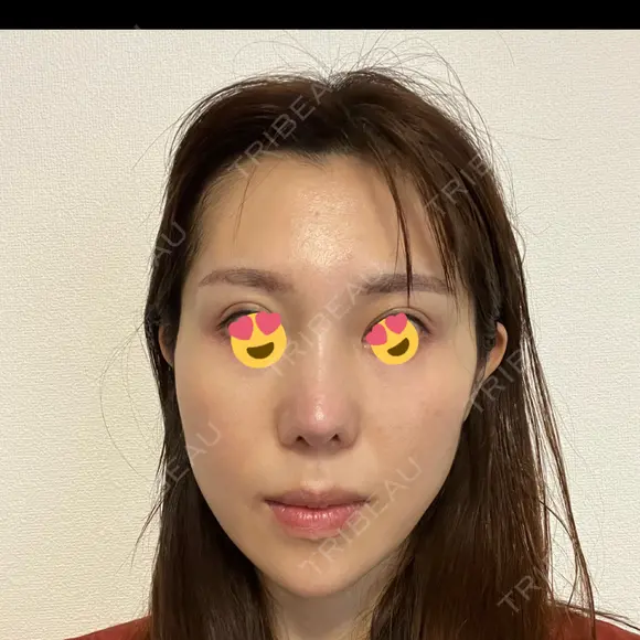 二重埋没 / 人中短縮 / 目尻切開 / 口角挙上 ヴェリテクリニック 名古屋院 BEFORE メイン用