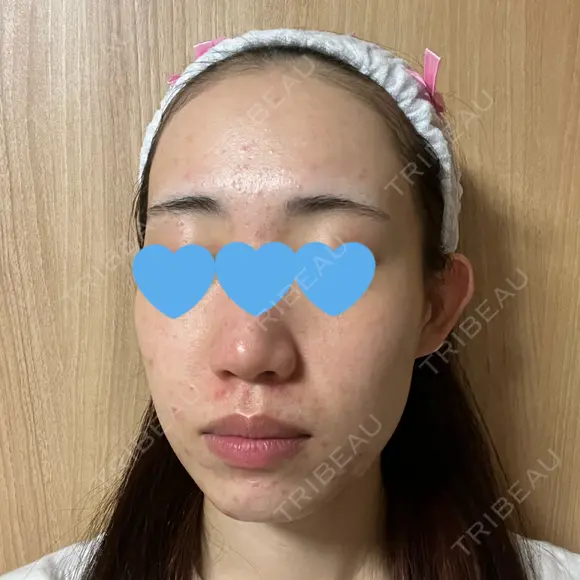 ポテンツァ レナータクリニック 立川院 BEFORE メイン用