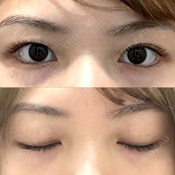 二重埋没 R.O.clinic BEFORE メイン用