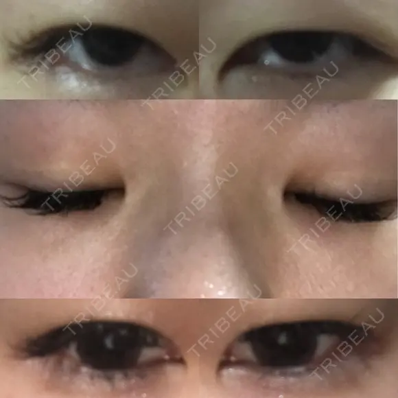 眼瞼下垂（切開） ピュア形成外科医院 BEFORE メイン用