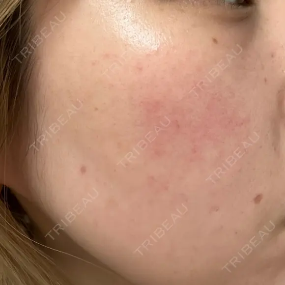 毛穴洗浄（ハイドラフェイシャルなど） / ピコフラクショナルレーザー（毛穴・ニキビ跡） CHARIS BEAUTY CLINIC BEFORE メイン用