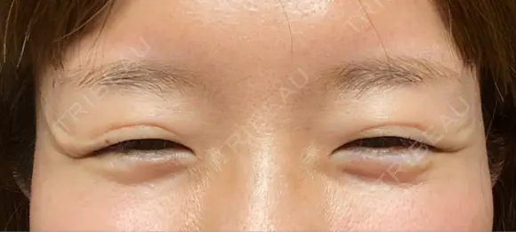 ボトックス（目尻） TCB東京中央美容外科 大宮東口院 BEFORE メイン用