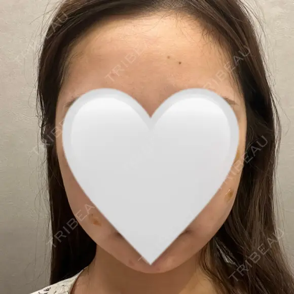 インディバ（顔） WOM SALON【術後ケア取扱いサロン】 BEFORE メイン用
