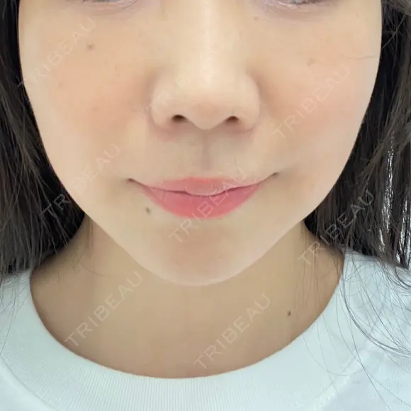 ハイフ（顔） TCB東京中央美容外科 岡山院 BEFORE メイン用