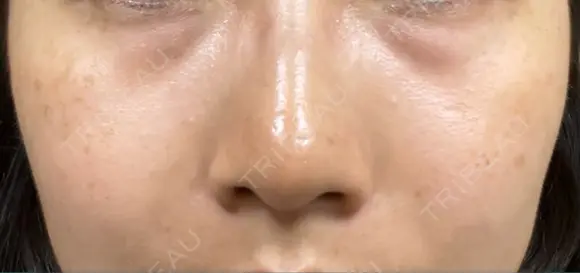 レーザートーニング（美白・肝斑） 渋谷美容外科クリニック 横浜院 BEFORE メイン用