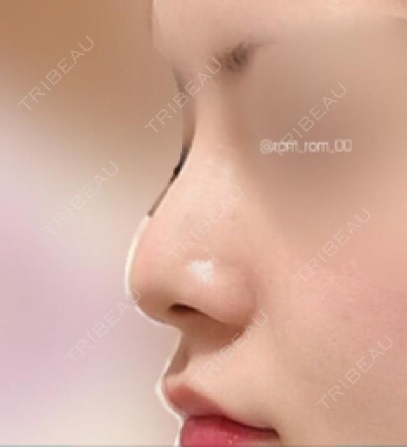 鼻尖形成（切開） / 鼻中隔延長（切開） / 軟骨移植 / 眉間プロテーゼ / 鼻修正 ミナ美容外科 BEFORE メイン用