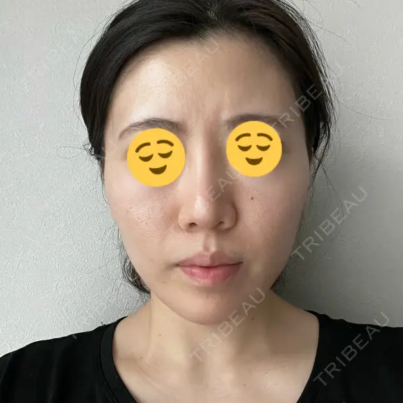 イオン導入 / ピーリング（ハリ・ツヤ） 湘南美容クリニック 静岡院 BEFORE メイン用