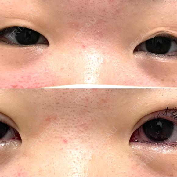 二重埋没 / クマ治療 NARU Beauty Clinic 【ナルクリ】 BEFORE メイン用