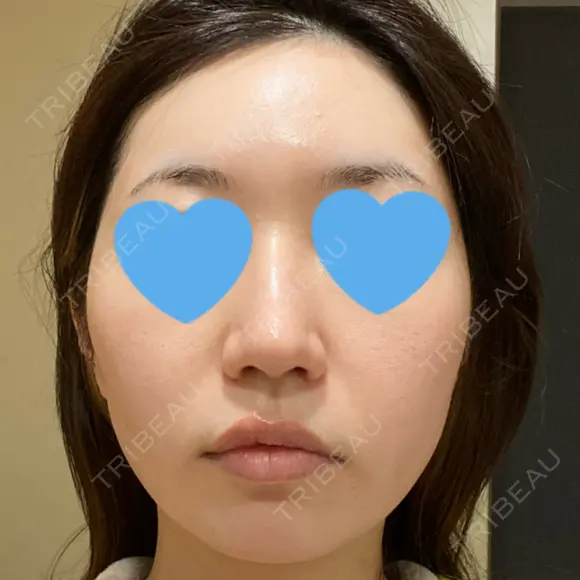 ピーリング（ニキビ・毛穴） / ピコフラクショナルレーザー（毛穴・ニキビ跡） CLINICA BellaForma BEFORE メイン用