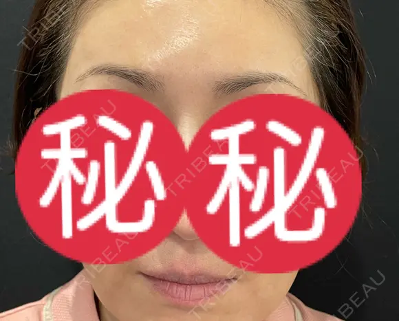 アートメイク（眉） / アートメイク（唇） APスキンクリニック銀座 BEFORE メイン用