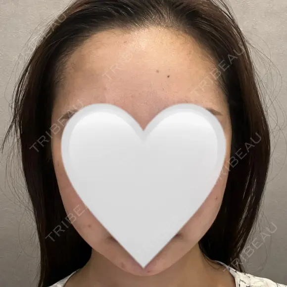 インディバ（顔） WOM SALON【術後ケア取扱いサロン】 BEFORE メイン用