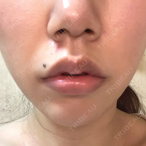 口角挙上 宇都宮竹内クリニック BEFORE メイン用
