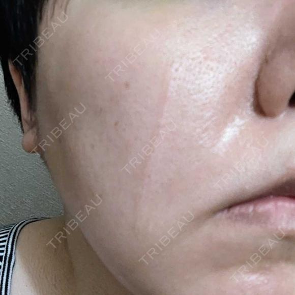 傷跡修正 / ダーマペン 品川美容外科 町田院 BEFORE メイン用