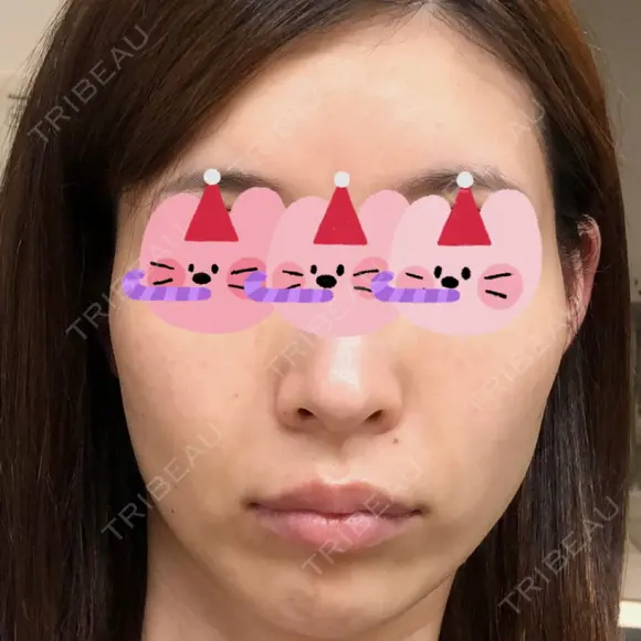 糸リフト / 額を丸く / こめかみ形成 / 脂肪注入（額） eクリニック 金沢本院 BEFORE メイン用