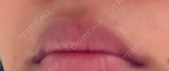 医療脱毛（顔） 美容皮膚科エルムクリニック 京都院 BEFORE メイン用