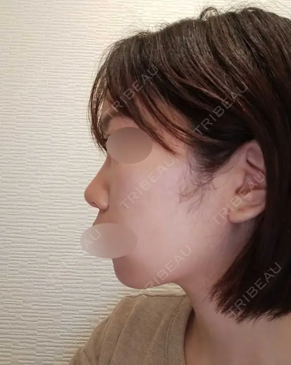 鼻中隔延長（切開） / 小鼻縮小（切開） / あごプロテーゼ ビーザニュー美容整形外科（旧コノピ美容整形外科） BEFORE メイン用