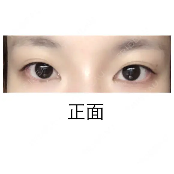 二重切開 水の森美容クリニック 大阪梅田院 BEFORE メイン用