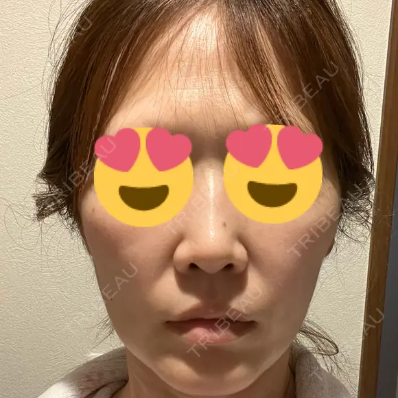 脂肪注入（輪郭） X CLINIC 恵比寿院 BEFORE メイン用
