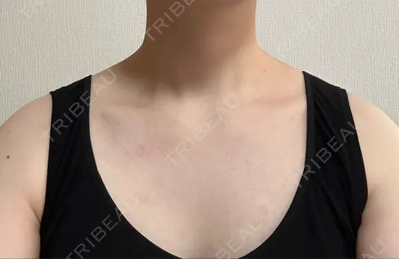 ボトックス（肩） L‘amour clinic Tokyo【ラムールクリニック東京】 BEFORE メイン用