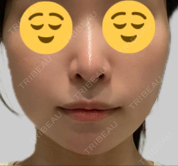 ボトックス（エラ・小顔） KARIS beauty clinic BEFORE メイン用
