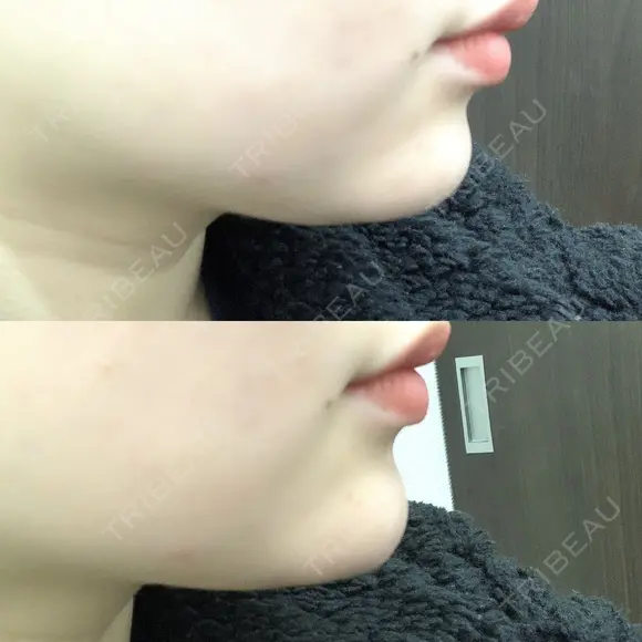 ヒアルロン酸注入（あご） / ボトックス（エラ・小顔） TCB東京中央美容外科 堺院 BEFORE メイン用