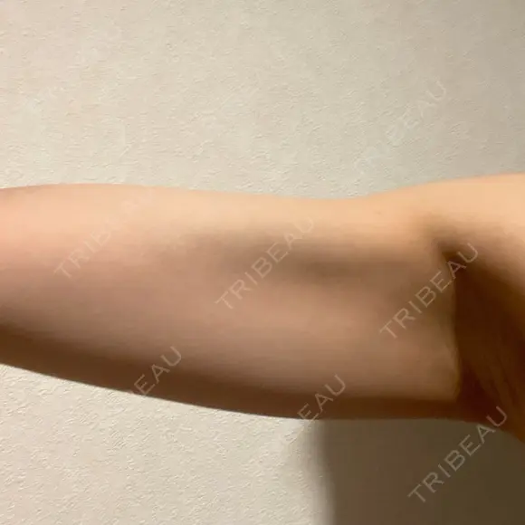 脂肪溶解注射 / その他 HAAB BEAUTY CLINIC 名古屋院 BEFORE メイン用