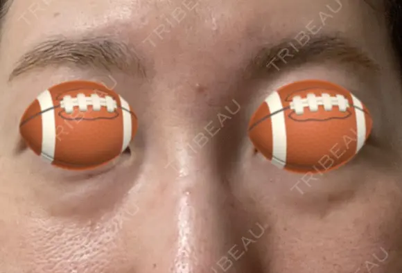 下まぶたの脂肪取り あじまビューティークリニック BEFORE メイン用