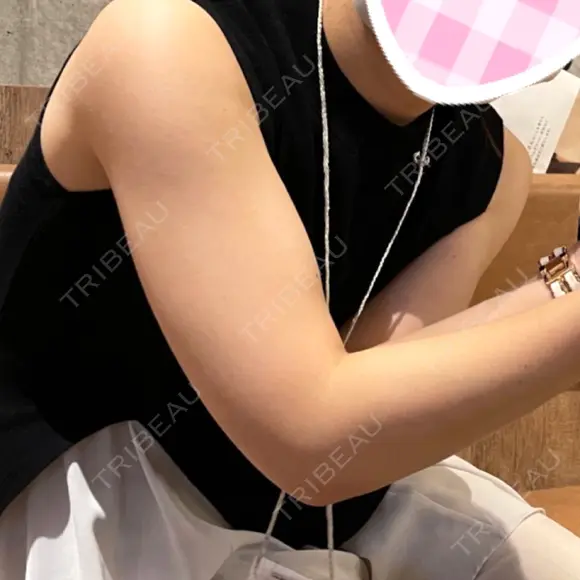 脂肪吸引（二の腕） / 脂肪吸引（肩） 湘南美容クリニック 渋谷院 BEFORE メイン用