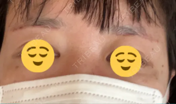 アートメイク（眉） メディカルアートメイク大阪 BEFORE メイン用