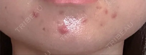 その他（肌） / ニードルRF（ポテンツァなど） KM新宿クリニック BEFORE メイン用