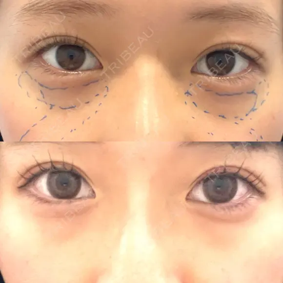 クマ治療 X CLINIC 銀座院 BEFORE メイン用
