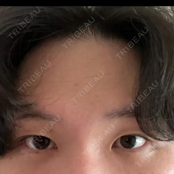 眼瞼下垂（切開） シェリークリニック 福岡院 BEFORE メイン用