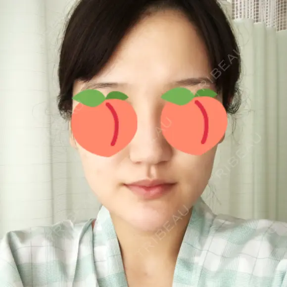 骨切り（あご） / 骨削り（エラ） / ルフォー+ssro（両あご) リラ・クラニオフェイシャル・クリニック BEFORE メイン用