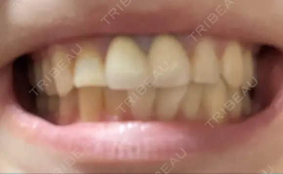 セラミック / ラミネートベニア / その他（口元） 東京銀座A CLINIC デンタル BEFORE メイン用