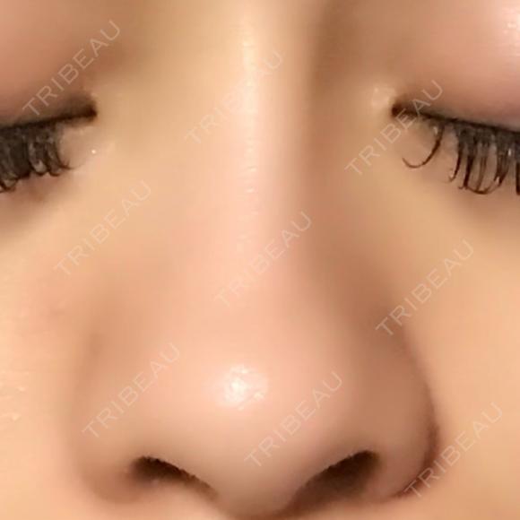 隆鼻術 / 鼻尖形成（切開） / 鼻中隔延長（切開） / 軟骨移植 / プロテーゼ除去 / 鼻修正 湘南美容クリニック 新宿本院 BEFORE メイン用