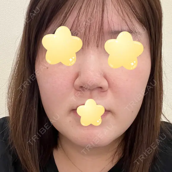 隆鼻術 / 鼻尖形成（切開） / 軟骨移植 エースクリニック 名古屋院 BEFORE メイン用