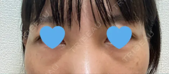 クマ治療 / 下まぶたたるみ取り / 下まぶたの脂肪取り / 脂肪注入（目の下） お茶の水美容形成クリニック BEFORE メイン用