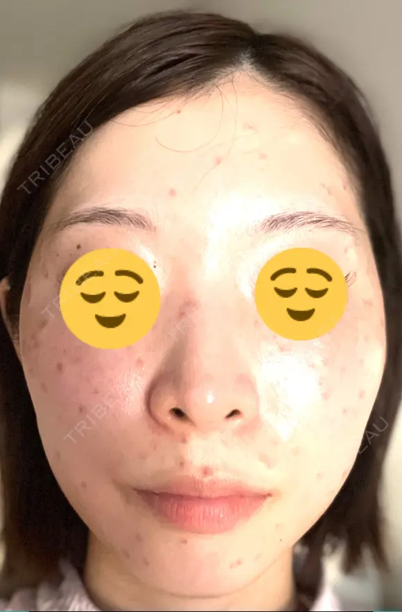 シミ取りレーザー Mavie Beauty Clinic （マヴィービューティークリニック） BEFORE メイン用