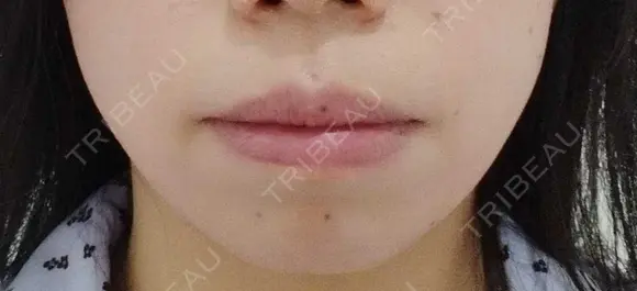 ボトックス（口角） YBC横浜美容外科 大宮院 BEFORE メイン用