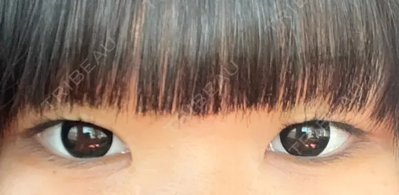 二重埋没 ルラ美容クリニック 名古屋本院 BEFORE メイン用