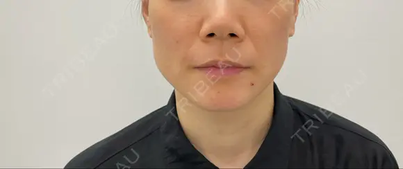 糸リフト 東郷美容形成外科　福岡 BEFORE メイン用