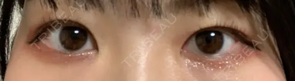 二重埋没 / 眼瞼下垂（非切開） BRIGHTS beauty clinic BEFORE メイン用